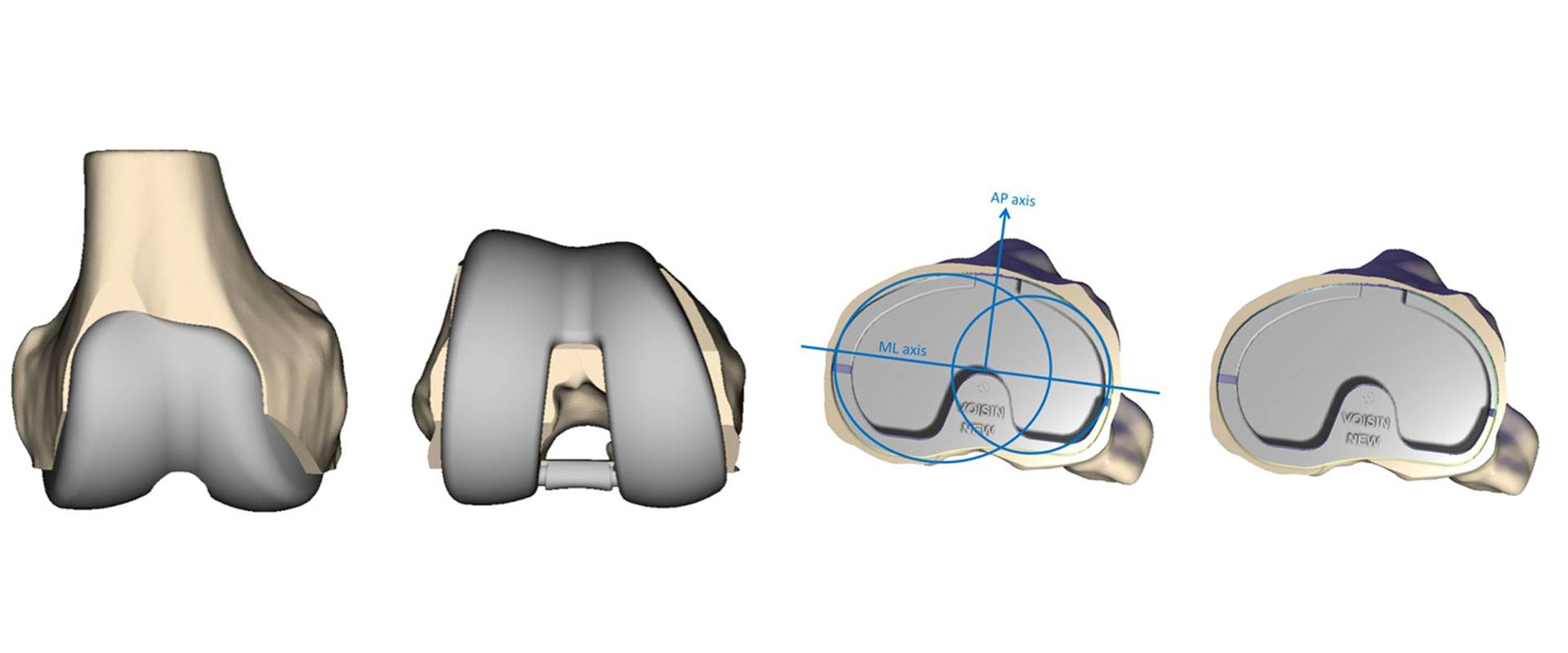 Grafische Darstellung Knie mit Individualprothese verschiedene Blickwinkel